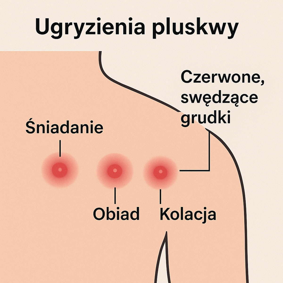 ugryzieniapluskwy